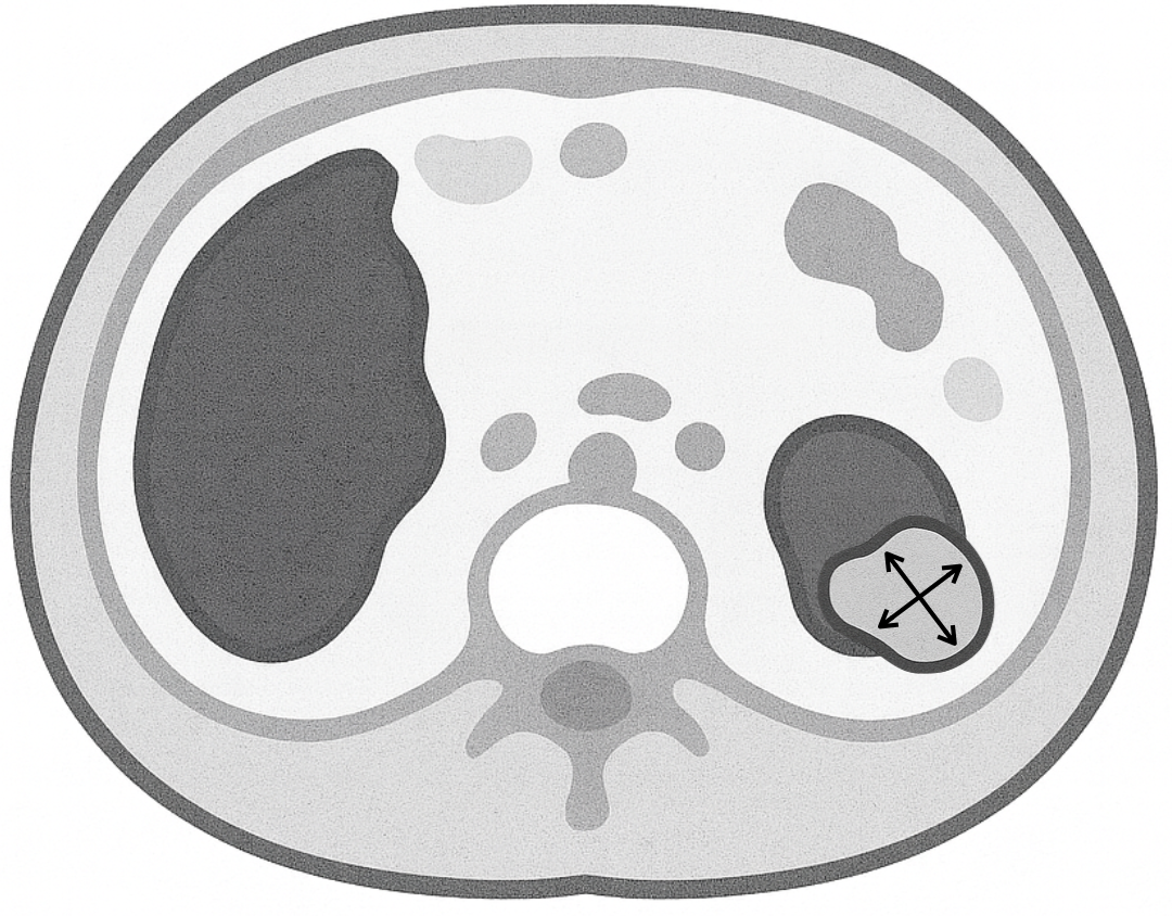 Tumor Lesion Sizing example